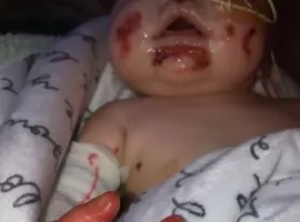 Please Donate To Reduce Baby’s Pain And Help to Save Her