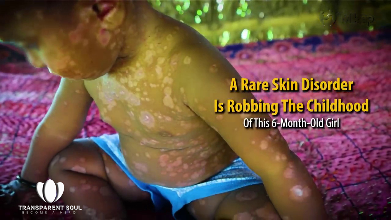 Save Avani’s Life Her body is covered in blisters – instead of helping, people have isolated Her